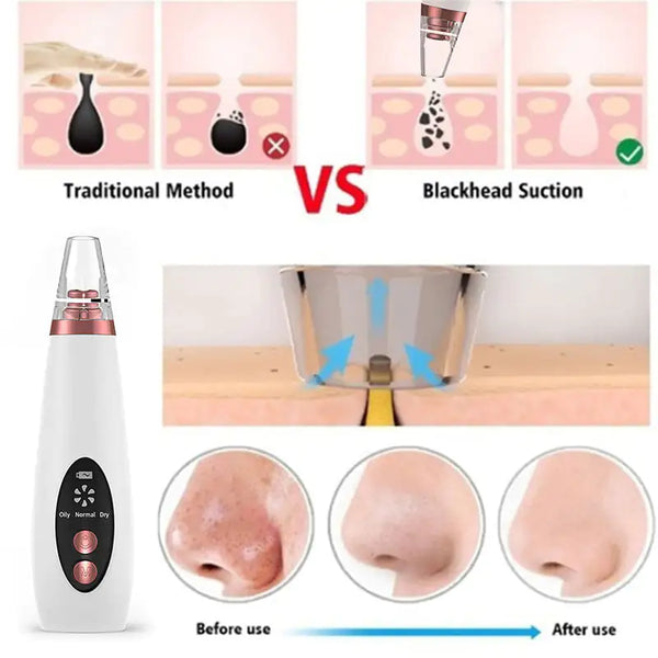 The Ultimate Blackhead Remover